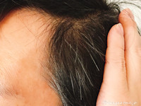 こめかみや耳周りの生え際に白髪が多い理由と対策